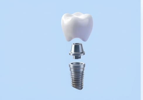 Dental implant